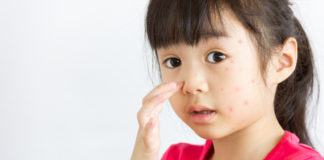 Alergi Pada Anak