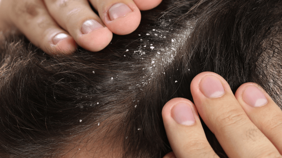 Cara Menghilangkan Ketombe Kering Tebal