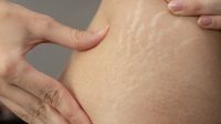 Cara Menghilangkan Stretch Mark Putih Cara Menghilangkan Stretch Mark Putih