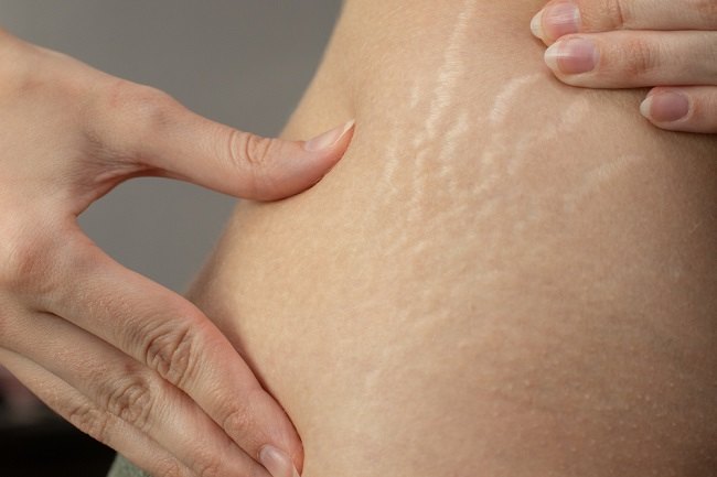 Cara Menghilangkan Stretch Mark Putih