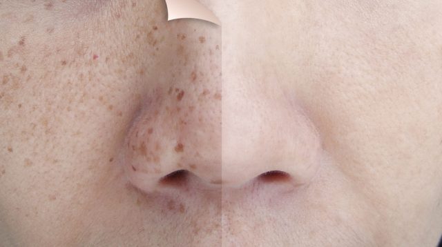 Menyamarkan Flek Hitam di Pipi Menyamarkan Flek Hitam di Pipi