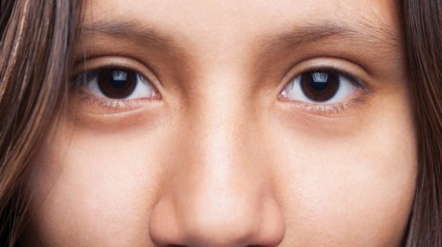 Cara Mengatasi Kantung Mata Hitam Cara Mengatasi Kantung Mata Hitam