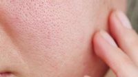 Cara Mengecilkan Pori-Pori Wajah