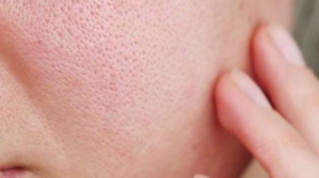 Cara Mengecilkan Pori-Pori Wajah