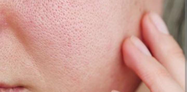 Cara Mengecilkan Pori-Pori Wajah