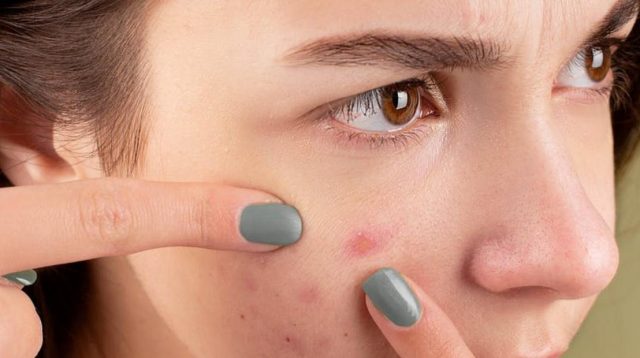 10 Cara Menghilangkan Jerawat Batu dalam Waktu Singkat